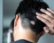 Lầm tưởng thường gặp về chứng rụng tóc từng mảng