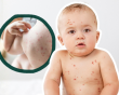 Cách giảm ngứa khi mắc thủy đậu