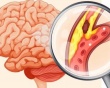 Những ai dễ bị nhồi máu não?