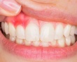 Mách bạn 5 cách cải thiện viêm lợi tại nhà