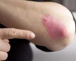 Dùng thảo dược tăng miễn dịch - hướng tiếp cận bền vững khi bị vảy nến