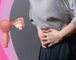 Giải pháp giúp kiểm soát u nang buồng trứng an toàn 