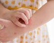 Giải pháp thảo dược cho trẻ bị nổi mề đay
