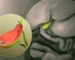 Sỏi bùn mật ít gây đau, dùng TPBVSK Kim Đởm Khang được không? 