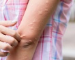 Nổi mề đay mùa Hè, phải làm sao?