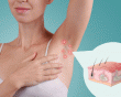 Sống chung với viêm tuyến mồ hôi mủ trong mùa Hè