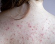 Bị mụn lưng phải làm sao?