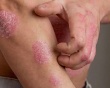 Bị vảy nến có chữa được không?
