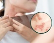 Lupus ban đỏ dạng đĩa có nguy hiểm không? 