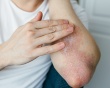 Nguyên nhân nào khiến vảy nến lan ra toàn thân?