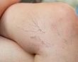 Biện pháp cải thiện suy giãn tĩnh mạch tại nhà