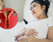 Đột phá điều trị lạc nội mạc tử cung bằng sóng cao tần