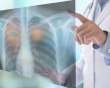 Dấu hiệu nhận biết u phổi lành tính và ác tính