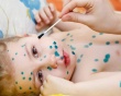 Những sai lầm thường gặp khi chữa thủy đậu cho trẻ?