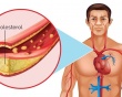 Bảo vệ trái tim trước mối nguy do tăng cholesterol