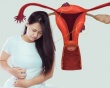 Sang chấn tâm lý có thể thúc đẩy bệnh lạc nội mạc tử cung