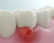 Đừng chủ quan với viêm chân răng!