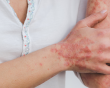 Những hiểu lầm khiến người bệnh vảy nến thêm tự ti