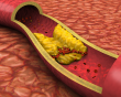 Cholesterol cao và xơ vữa động mạch: Mối liên hệ nhiều người còn chủ quan