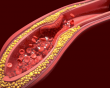 Cục máu đông gây tắc mạch não: Vì sao cần phát hiện sớm?