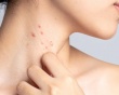 Hướng đi mới giúp kiểm soát bệnh lupus ban đỏ từ thảo dược tự nhiên