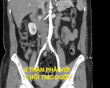 Tình cờ phát hiện u thận kèm huyết khối tĩnh mạch chủ
