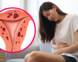 Vì sao lạc nội mạc tử cung thuờng được phát hiện muộn?