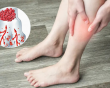 4 dấu hiệu cảnh báo cục máu đông phụ nữ không nên chủ quan