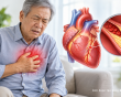 Hẹp mạch vành 45% phải làm gì để tránh đặt stent?