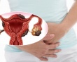 Đau bụng kinh do lạc nội mạc tử cung - cách nào để cải thiện?