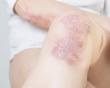 Chủ động kiểm soát vảy nến từ sớm để không lo bệnh bùng phát khi trời lạnh