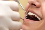 Bệnh nướu răng liên quan viêm khớp