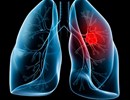 ung thư phổi: Những nguyên nhân không ngờ