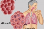 Viêm phổi – Biến chứng nhanh cực nguy hiểm