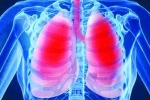 Nguy cơ viêm phổi tụ cầu sau mụn nhọt