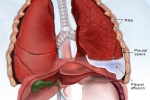 Tràn dịch màng phổi: Gánh nặng sức khỏe và kinh tế
