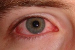 Vì sao mắt nhìn mờ sau khi điều trị viêm kết mạc?