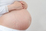 6 mẹo hay để không bị rạn da khi mang thai