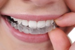 Những điều cần lưu ý khi tẩy trắng răng