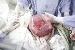 Mổ lấy khối u to như quả dưa hấu ở bụng dưới