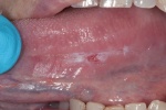 Biểu hiện ung thư lưỡi dễ bị nhầm với nhiệt miệng