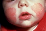 Eczema và các thể bệnh phổ biến nhất