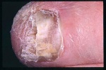 Nấm móng chân có thể chữa khỏi không?