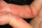 5 mẹo chăm sóc vùng da bị tổn thương do eczema