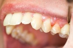 Video: Biến chứng răng miệng ở bệnh nhân đái tháo đường