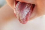 Nấm miệng, lưỡi trắng bợt dùng TPCN có ăn thua?