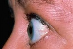 Chữa lồi mắt do bệnh cường tuyến giáp Basedow