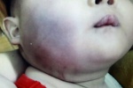 Trẻ 8 tháng bầm tím mặt khi rời nhà bảo mẫu