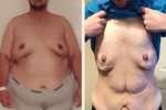 Chàng trai chi 15.000 bảng Anh cắt da thừa sau khi giảm 100kg