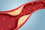 Xơ vữa động mạch là gì?